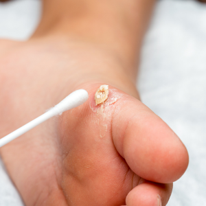 reason for foot corn